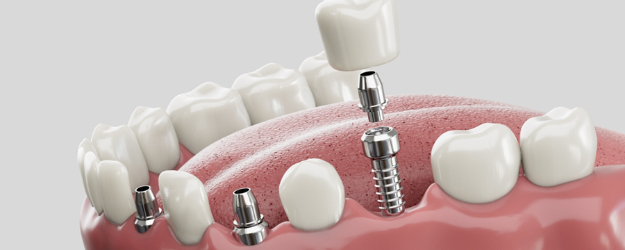 Are Dental Implants Affordable?