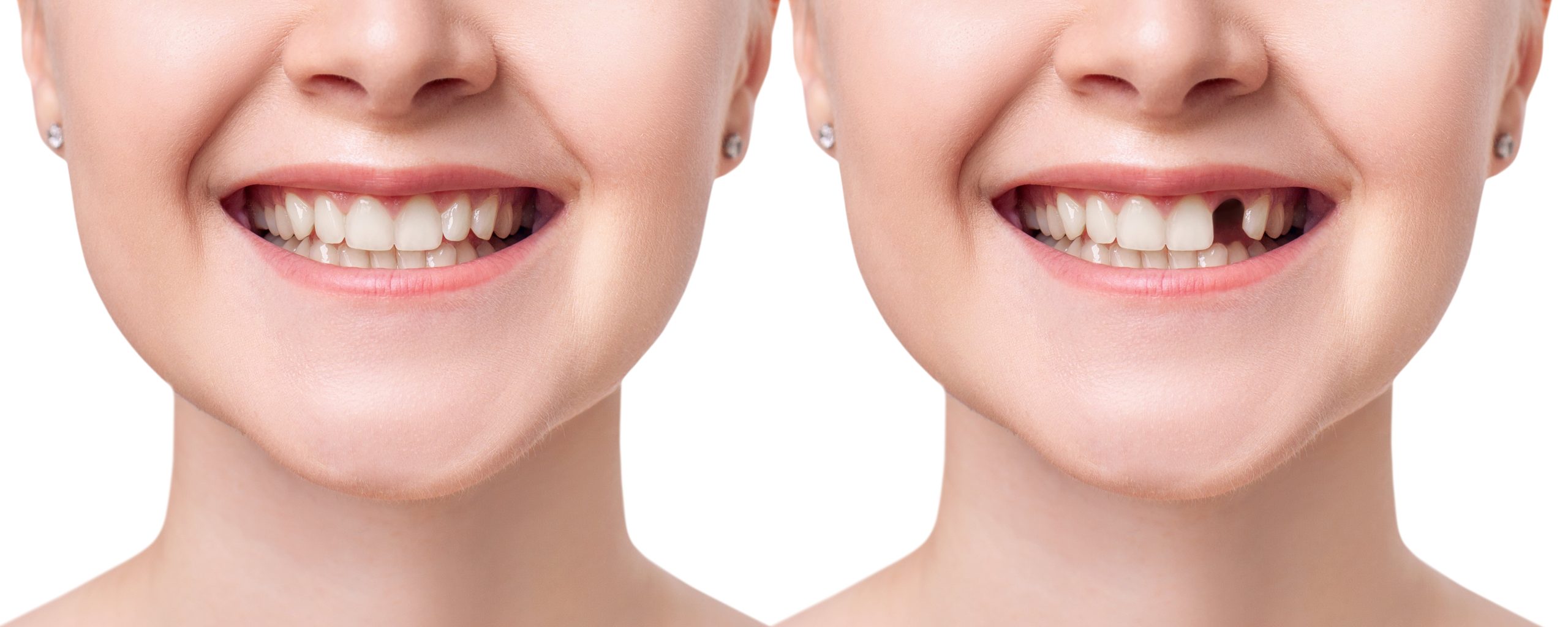 What Are Screwless Dental Implants